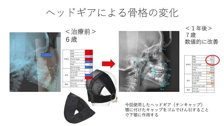 成長期の受け口の改善