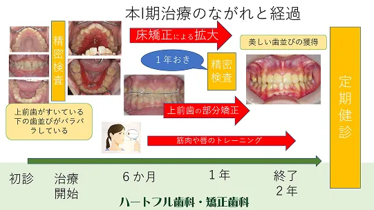拡大床＋前歯部分矯正＋MFT