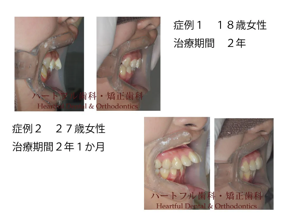 抜歯矯正