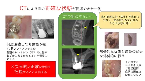 CT診断