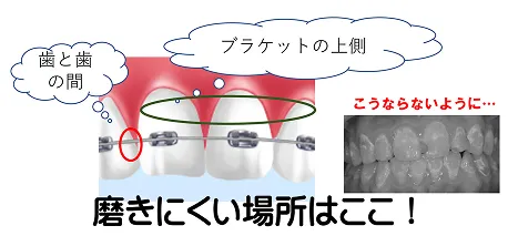 むし歯予防