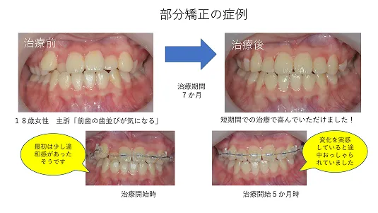部分矯正
