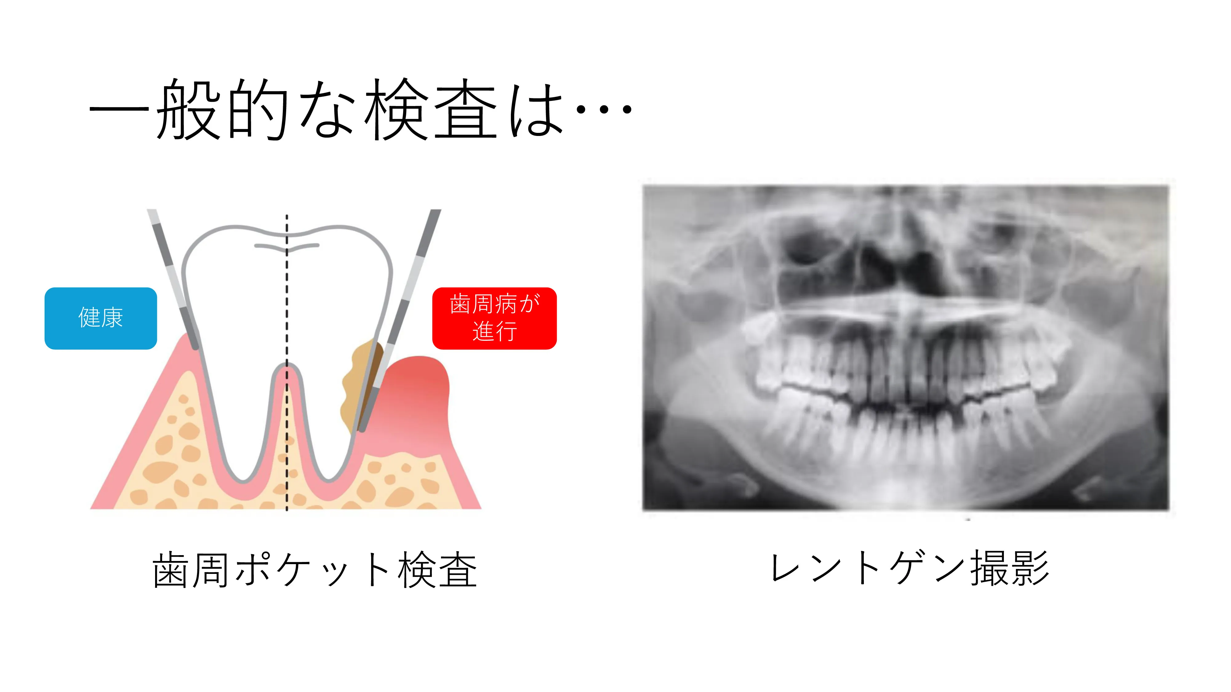 歯周病治療