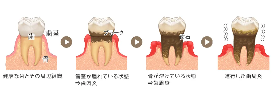 歯周病治療