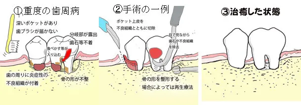 進行した歯周病