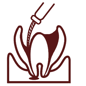 根管治療